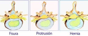 Protusiones Discales